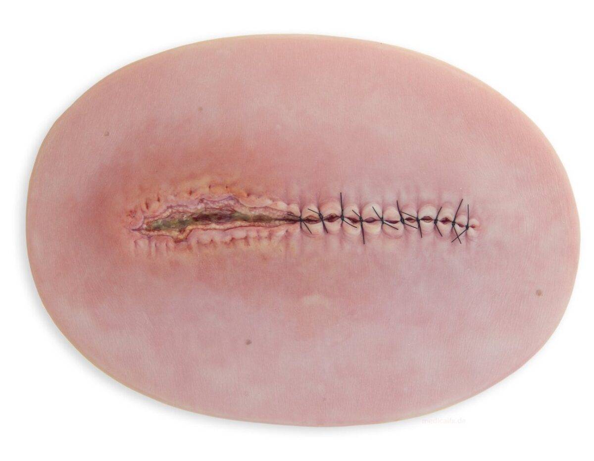 Das „Stick-On Medium OP Wunde, geöffnet"-Modell von MEDICAL FX Germany ist ein hochwertiges, mittelgroßes Silikonmodell zur Darstellung einer offenen Operationswunde. Es zeichnet…