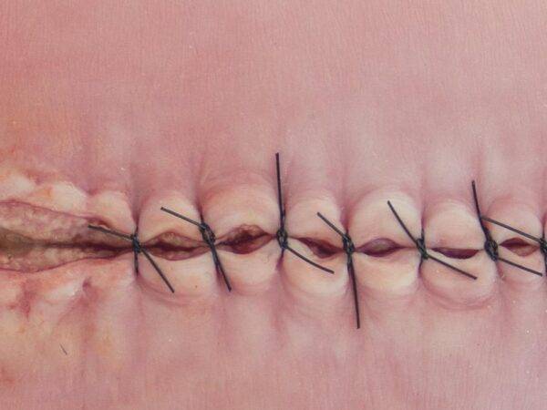 Das „Stick-On Medium OP Wunde, geöffnet"-Modell von MEDICAL FX Germany ist ein hochwertiges, mittelgroßes Silikonmodell zur Darstellung einer offenen Operationswunde. Es zeichnet…