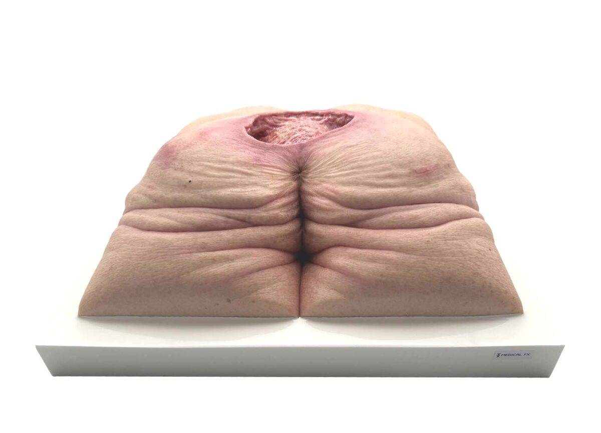 Das „Rahmenmodell Gesäß-Dekubitus" von MEDICAL FX Germany ist eine präzise Nachbildung eines fortgeschrittenen Druckgeschwürs im Sakralbereich, gefertigt aus hochwertigem Silikon.…