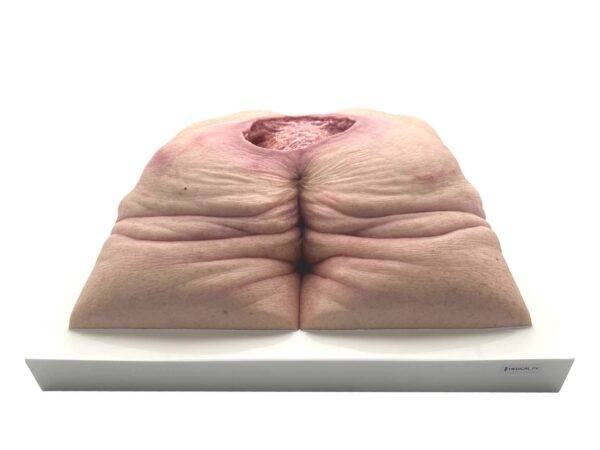 Das „Rahmenmodell Gesäß-Dekubitus" von MEDICAL FX Germany ist eine präzise Nachbildung eines fortgeschrittenen Druckgeschwürs im Sakralbereich, gefertigt aus hochwertigem Silikon.…