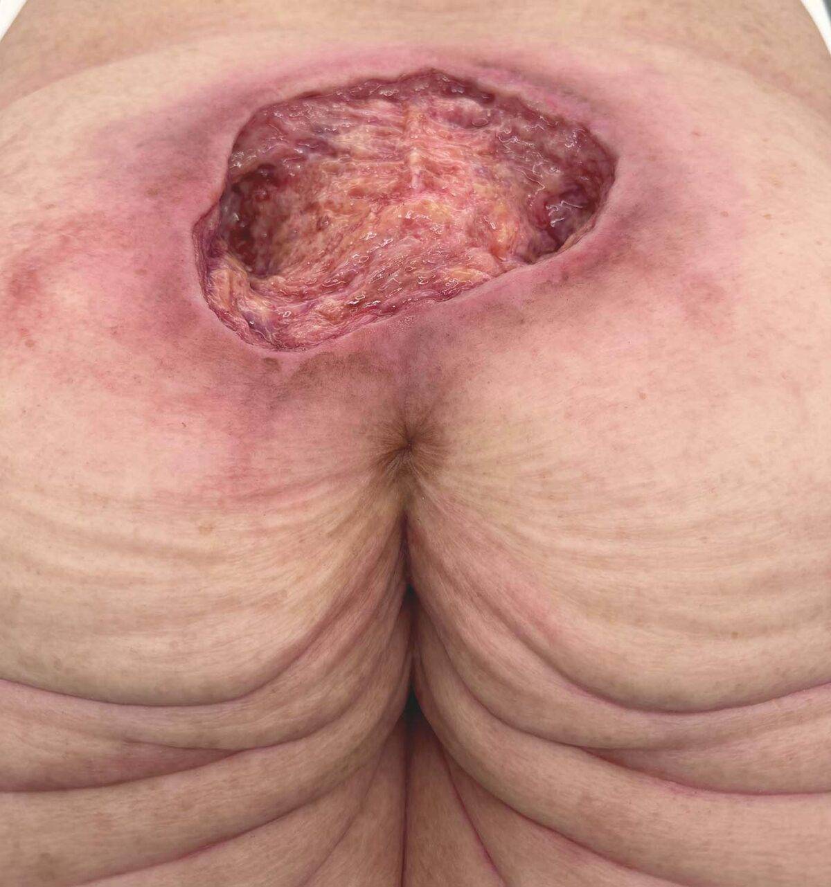 Das „Rahmenmodell Gesäß-Dekubitus" von MEDICAL FX Germany ist eine präzise Nachbildung eines fortgeschrittenen Druckgeschwürs im Sakralbereich, gefertigt aus hochwertigem Silikon.…