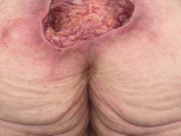 Das „Rahmenmodell Gesäß-Dekubitus" von MEDICAL FX Germany ist eine präzise Nachbildung eines fortgeschrittenen Druckgeschwürs im Sakralbereich, gefertigt aus hochwertigem Silikon.…