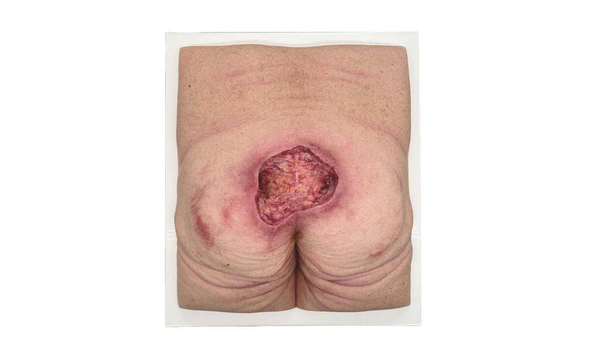 Das „Rahmenmodell Gesäß-Dekubitus" von MEDICAL FX Germany ist eine präzise Nachbildung eines fortgeschrittenen Druckgeschwürs im Sakralbereich, gefertigt aus hochwertigem Silikon.…