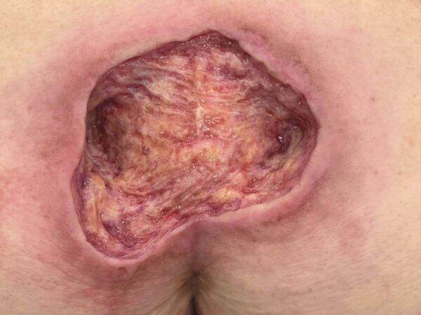 Das „Rahmenmodell Gesäß-Dekubitus" von MEDICAL FX Germany ist eine präzise Nachbildung eines fortgeschrittenen Druckgeschwürs im Sakralbereich, gefertigt aus hochwertigem Silikon.…