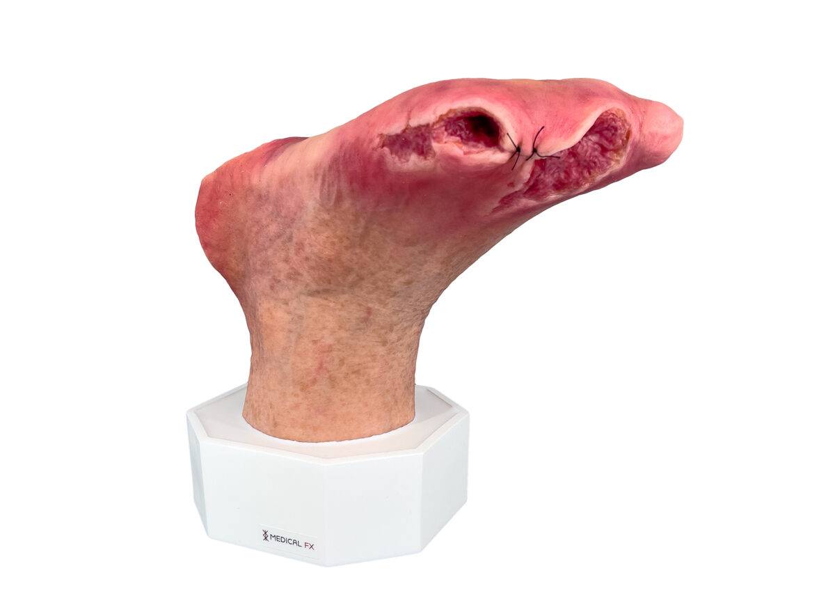 Das „Sockelmodell Diabetisches Fußsyndrom mit 7 Wunden" von MEDICAL FX Germany visualisiert präzise die Folgen des diabetischen Fußsyndroms. Die dargestellten Wunden umfassen Zehe…