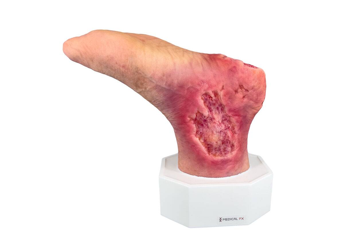 Das „Sockelmodell Diabetisches Fußsyndrom mit 7 Wunden" von MEDICAL FX Germany visualisiert präzise die Folgen des diabetischen Fußsyndroms. Die dargestellten Wunden umfassen Zehe…