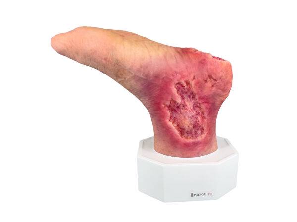 Das „Sockelmodell Diabetisches Fußsyndrom mit 7 Wunden" von MEDICAL FX Germany visualisiert präzise die Folgen des diabetischen Fußsyndroms. Die dargestellten Wunden umfassen Zehe…