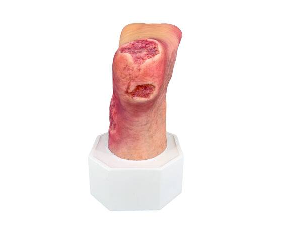 Das „Sockelmodell Diabetisches Fußsyndrom mit 7 Wunden" von MEDICAL FX Germany visualisiert präzise die Folgen des diabetischen Fußsyndroms. Die dargestellten Wunden umfassen Zehe…