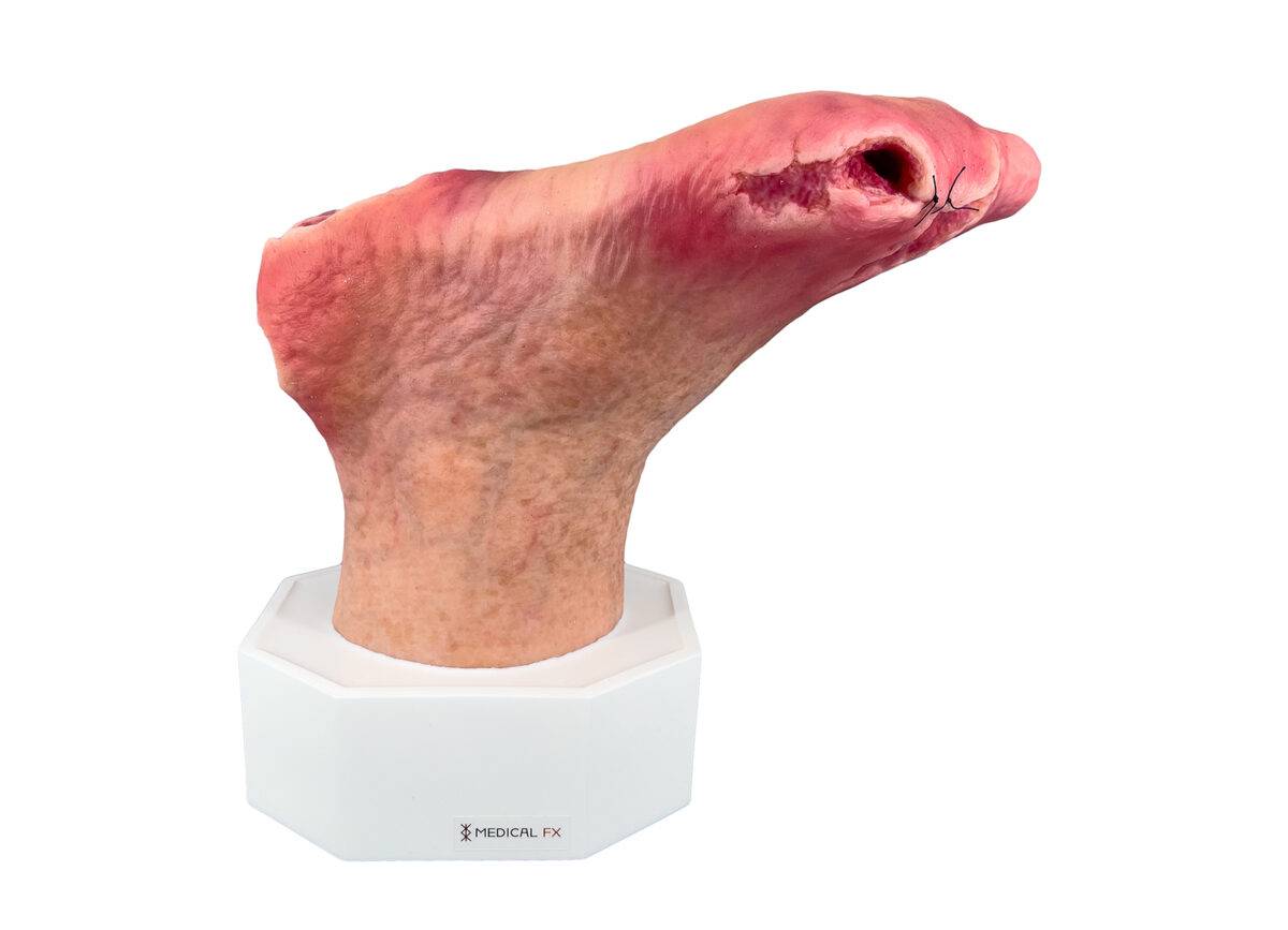 Das „Sockelmodell Diabetisches Fußsyndrom mit 7 Wunden" von MEDICAL FX Germany visualisiert präzise die Folgen des diabetischen Fußsyndroms. Die dargestellten Wunden umfassen Zehe…
