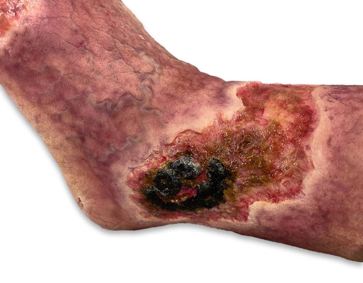 Das „Sockelmodell Nekrotischer Fuß" von MEDICAL FX Germany ist eine detailreiche Darstellung eines Fußes mit ausgeprägten nekrotischen Veränderungen. Dieses Modell ist auf einem S…