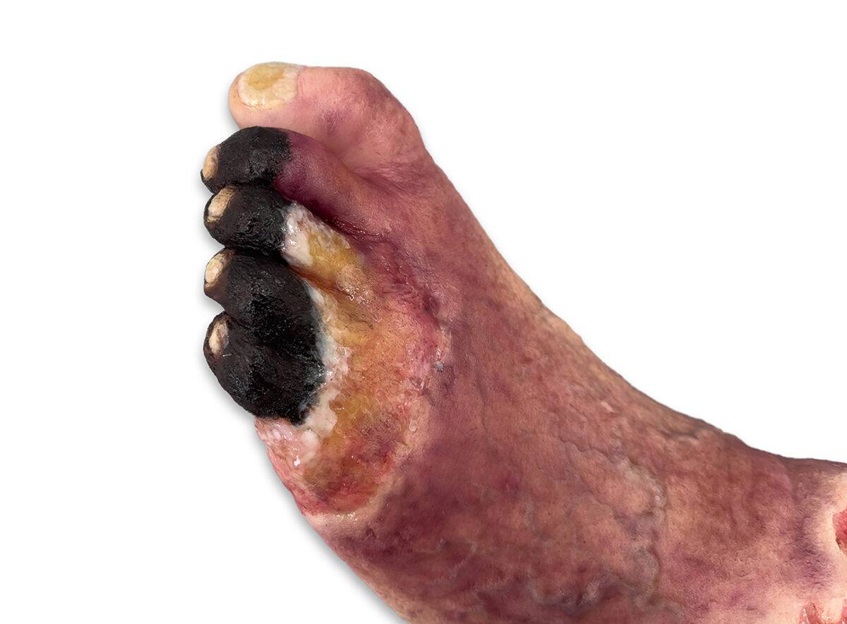 Das „Sockelmodell Nekrotischer Fuß" von MEDICAL FX Germany ist eine detailreiche Darstellung eines Fußes mit ausgeprägten nekrotischen Veränderungen. Dieses Modell ist auf einem S…