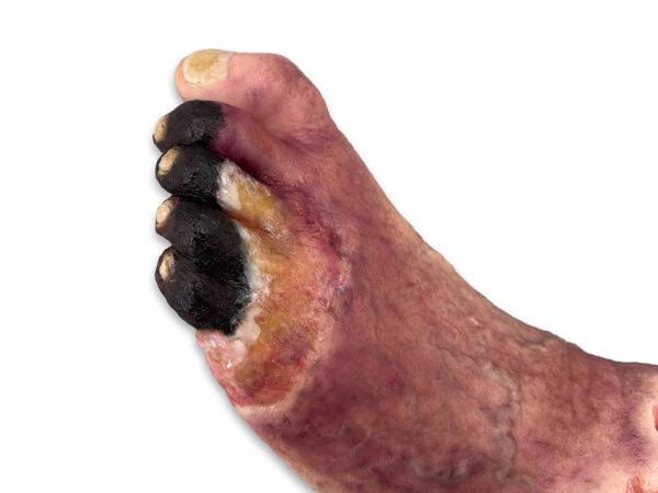 Das „Sockelmodell Nekrotischer Fuß" von MEDICAL FX Germany ist eine detailreiche Darstellung eines Fußes mit ausgeprägten nekrotischen Veränderungen. Dieses Modell ist auf einem S…