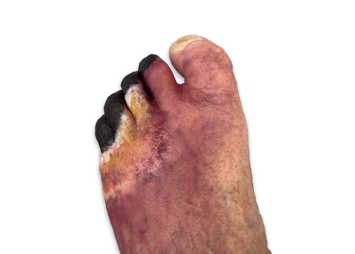 Das „Sockelmodell Nekrotischer Fuß" von MEDICAL FX Germany ist eine detailreiche Darstellung eines Fußes mit ausgeprägten nekrotischen Veränderungen. Dieses Modell ist auf einem S…