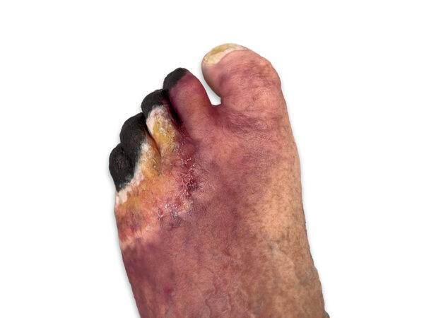 Das „Sockelmodell Nekrotischer Fuß" von MEDICAL FX Germany ist eine detailreiche Darstellung eines Fußes mit ausgeprägten nekrotischen Veränderungen. Dieses Modell ist auf einem S…