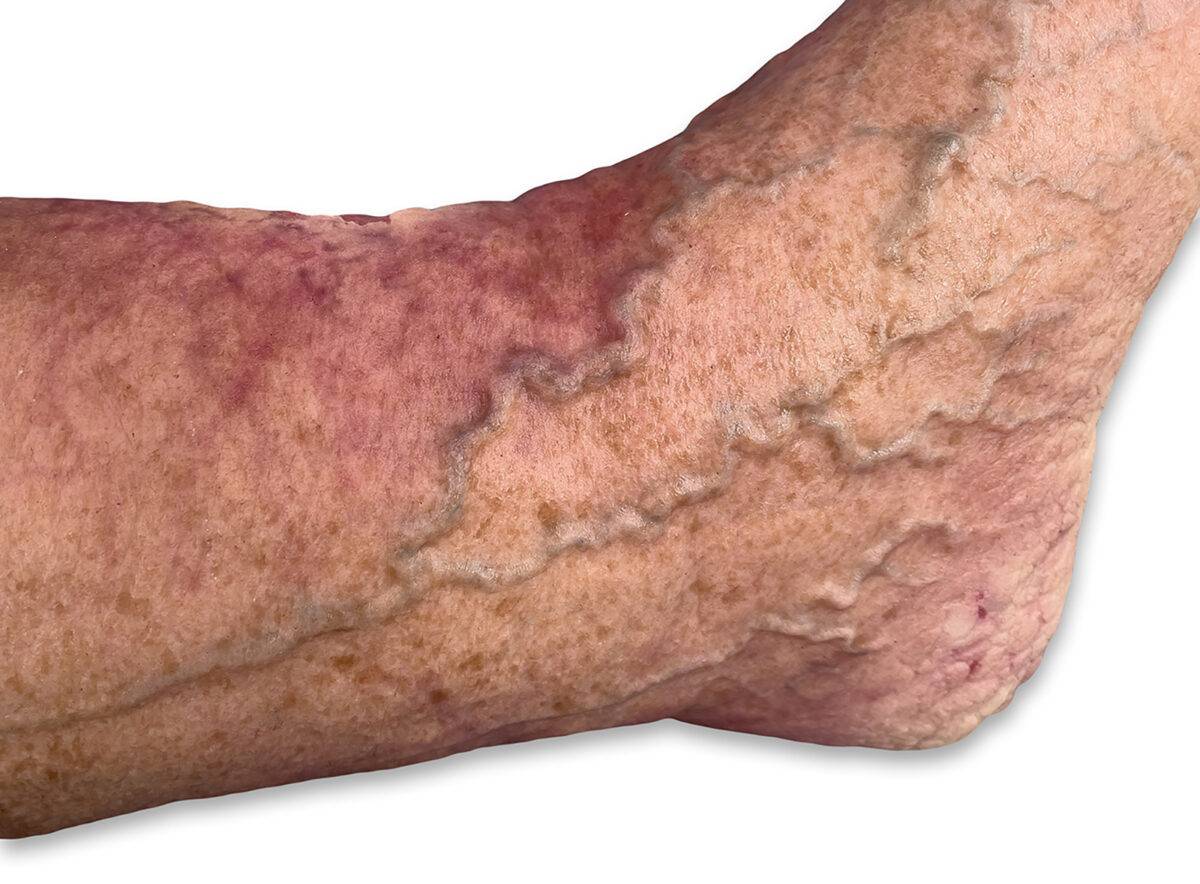 Das „Sockelmodell Nekrotischer Fuß" von MEDICAL FX Germany ist eine detailreiche Darstellung eines Fußes mit ausgeprägten nekrotischen Veränderungen. Dieses Modell ist auf einem S…