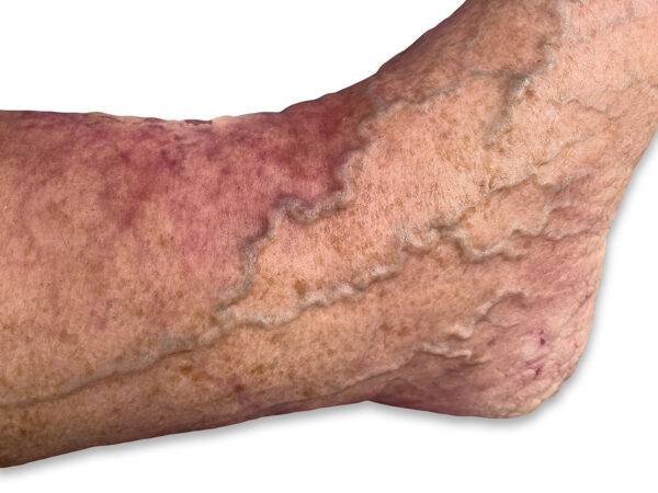 Das „Sockelmodell Nekrotischer Fuß" von MEDICAL FX Germany ist eine detailreiche Darstellung eines Fußes mit ausgeprägten nekrotischen Veränderungen. Dieses Modell ist auf einem S…