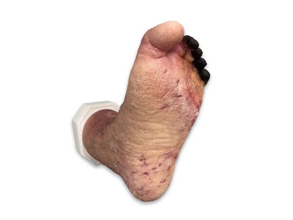 Das „Sockelmodell Nekrotischer Fuß" von MEDICAL FX Germany ist eine detailreiche Darstellung eines Fußes mit ausgeprägten nekrotischen Veränderungen. Dieses Modell ist auf einem S…