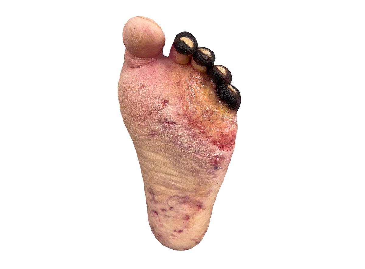 Das „Sockelmodell Nekrotischer Fuß" von MEDICAL FX Germany ist eine detailreiche Darstellung eines Fußes mit ausgeprägten nekrotischen Veränderungen. Dieses Modell ist auf einem S…