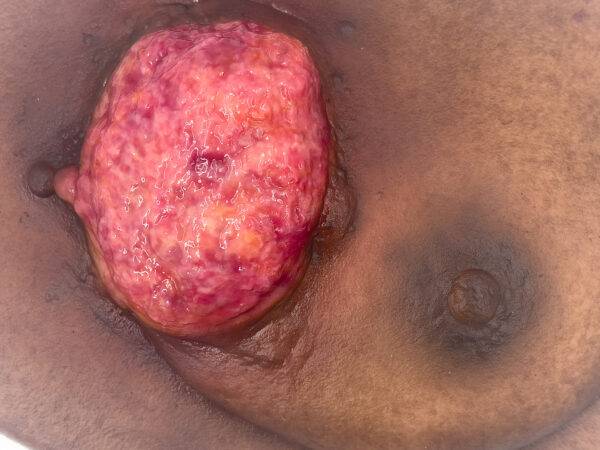 Das "Stick-On Medium Ulcerierendes Mamma-CA"-Modell von MEDICAL FX Germany simuliert ein fortgeschrittenes, ulzerierendes Brustkrebsgeschwür mit hoher Detailgenauigkeit und ist au…