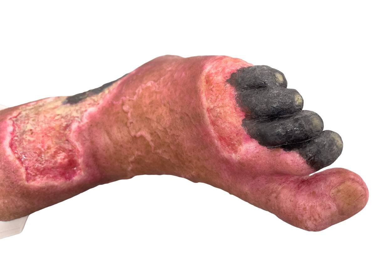 Das „Sockelmodell Nekrotischer Fuß" von MEDICAL FX Germany ist eine detailreiche Darstellung eines Fußes mit ausgeprägten nekrotischen Veränderungen. Dieses Modell ist auf einem S…