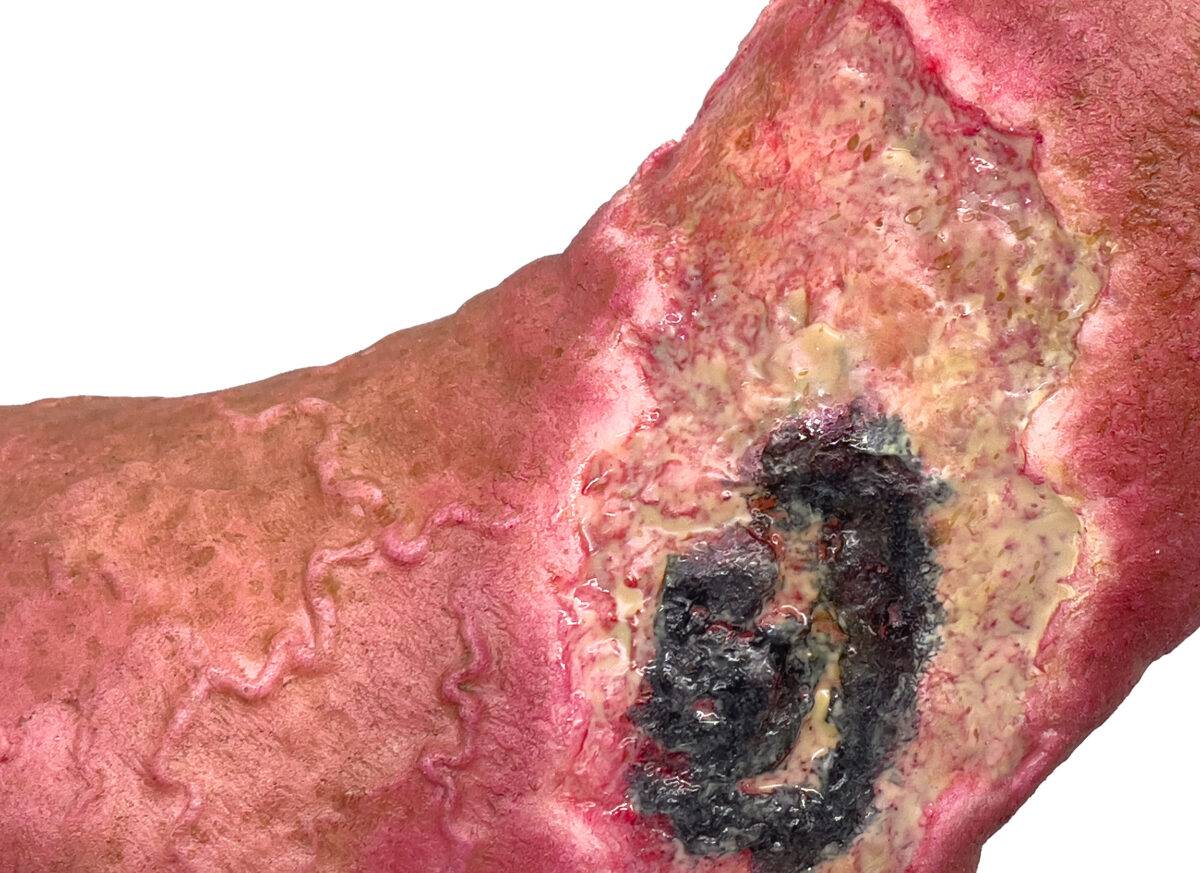 Das „Sockelmodell Nekrotischer Fuß" von MEDICAL FX Germany ist eine detailreiche Darstellung eines Fußes mit ausgeprägten nekrotischen Veränderungen. Dieses Modell ist auf einem S…