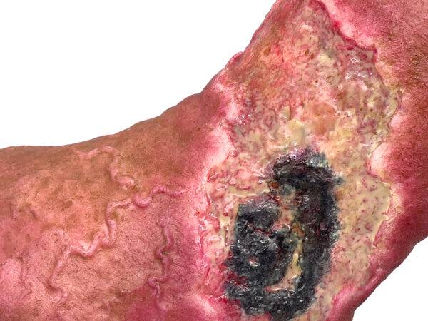 Das „Sockelmodell Nekrotischer Fuß" von MEDICAL FX Germany ist eine detailreiche Darstellung eines Fußes mit ausgeprägten nekrotischen Veränderungen. Dieses Modell ist auf einem S…