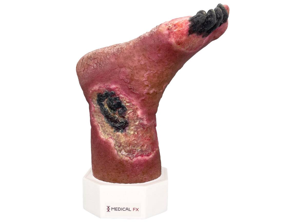 Das „Sockelmodell Nekrotischer Fuß" von MEDICAL FX Germany ist eine detailreiche Darstellung eines Fußes mit ausgeprägten nekrotischen Veränderungen. Dieses Modell ist auf einem S…