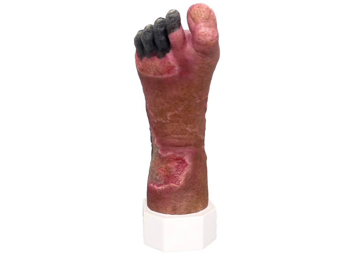 Das „Sockelmodell Nekrotischer Fuß" von MEDICAL FX Germany ist eine detailreiche Darstellung eines Fußes mit ausgeprägten nekrotischen Veränderungen. Dieses Modell ist auf einem S…