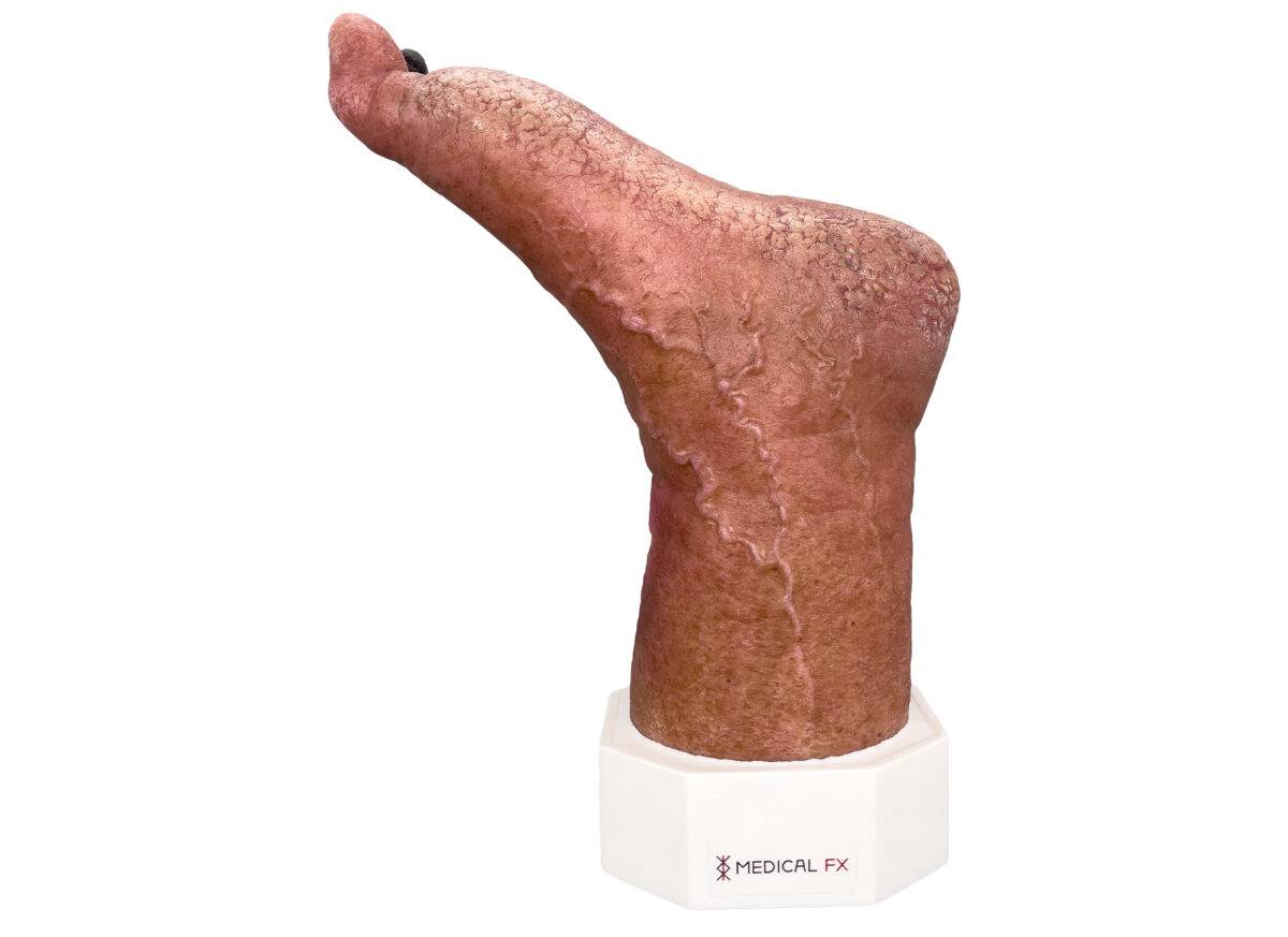 Das „Sockelmodell Nekrotischer Fuß" von MEDICAL FX Germany ist eine detailreiche Darstellung eines Fußes mit ausgeprägten nekrotischen Veränderungen. Dieses Modell ist auf einem S…