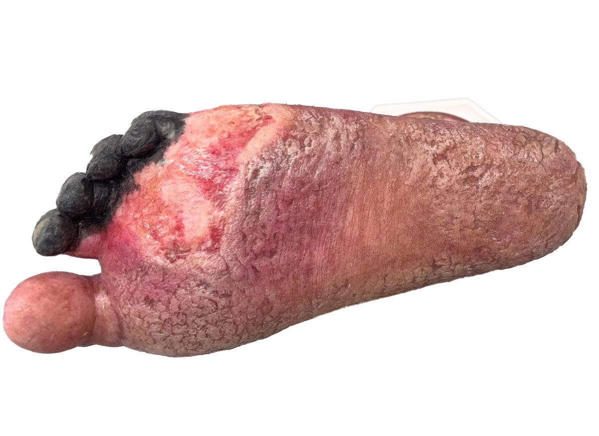 Das „Sockelmodell Nekrotischer Fuß" von MEDICAL FX Germany ist eine detailreiche Darstellung eines Fußes mit ausgeprägten nekrotischen Veränderungen. Dieses Modell ist auf einem S…