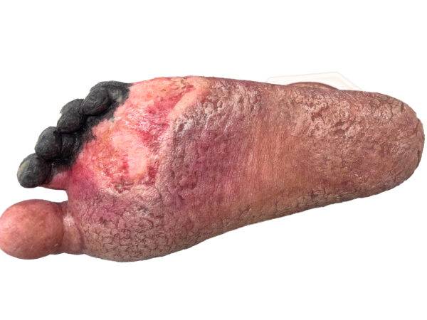 Das „Sockelmodell Nekrotischer Fuß" von MEDICAL FX Germany ist eine detailreiche Darstellung eines Fußes mit ausgeprägten nekrotischen Veränderungen. Dieses Modell ist auf einem S…