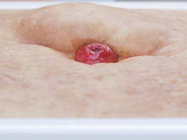 Das „Rahmenmodell Stoma Groß" von MEDICAL FX Germany repräsentiert ein hochwertig gefertigtes, großformatiges Modell eines Stomas, das speziell für Ausbildungs- und Schulungszweck…