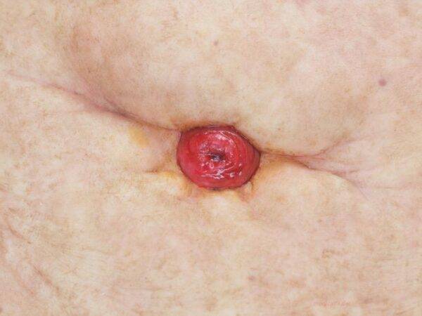 Das „Rahmenmodell Stoma Groß" von MEDICAL FX Germany repräsentiert ein hochwertig gefertigtes, großformatiges Modell eines Stomas, das speziell für Ausbildungs- und Schulungszweck…