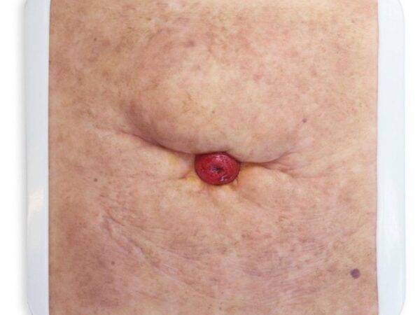 Das „Rahmenmodell Stoma Groß" von MEDICAL FX Germany repräsentiert ein hochwertig gefertigtes, großformatiges Modell eines Stomas, das speziell für Ausbildungs- und Schulungszweck…