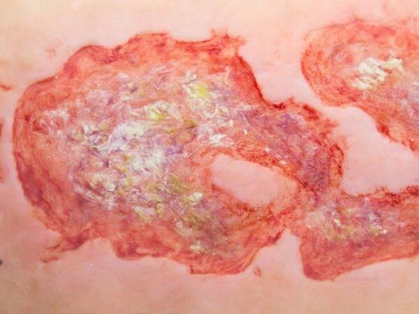 Das Modell „Stick-On Large Ulcus Cruris" von MEDICAL FX Germany simuliert ein großflächiges Unterschenkelgeschwür, typisch für venöse Insuffizienzen oder andere zirkulatorische Er…