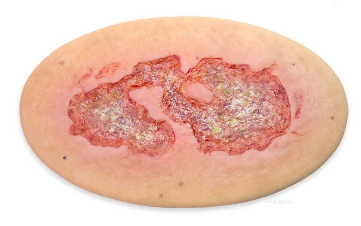 Das Modell „Stick-On Large Ulcus Cruris" von MEDICAL FX Germany simuliert ein großflächiges Unterschenkelgeschwür, typisch für venöse Insuffizienzen oder andere zirkulatorische Er…