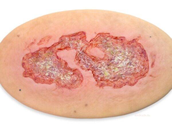 Das Modell „Stick-On Large Ulcus Cruris" von MEDICAL FX Germany simuliert ein großflächiges Unterschenkelgeschwür, typisch für venöse Insuffizienzen oder andere zirkulatorische Er…