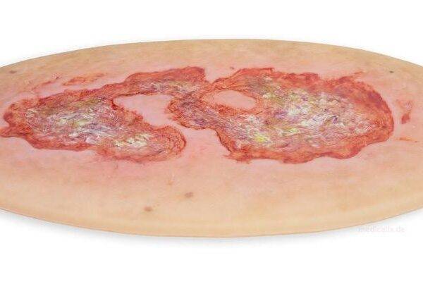Das Modell „Stick-On Large Ulcus Cruris" von MEDICAL FX Germany simuliert ein großflächiges Unterschenkelgeschwür, typisch für venöse Insuffizienzen oder andere zirkulatorische Er…