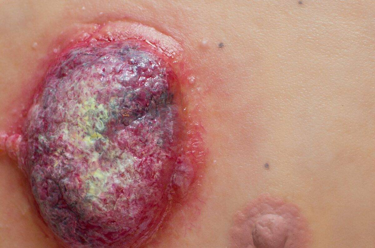 Das "Stick-On Medium Ulcerierendes Mamma-CA"-Modell von MEDICAL FX Germany simuliert ein fortgeschrittenes, ulzerierendes Brustkrebsgeschwür mit hoher Detailgenauigkeit und ist au…