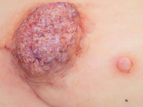 Das "Stick-On Medium Ulcerierendes Mamma-CA"-Modell von MEDICAL FX Germany simuliert ein fortgeschrittenes, ulzerierendes Brustkrebsgeschwür mit hoher Detailgenauigkeit und ist au…