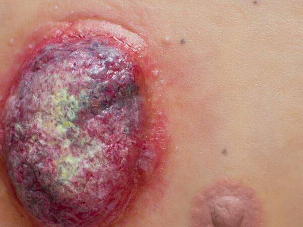 Das "Stick-On Medium Ulcerierendes Mamma-CA"-Modell von MEDICAL FX Germany simuliert ein fortgeschrittenes, ulzerierendes Brustkrebsgeschwür mit hoher Detailgenauigkeit und ist au…