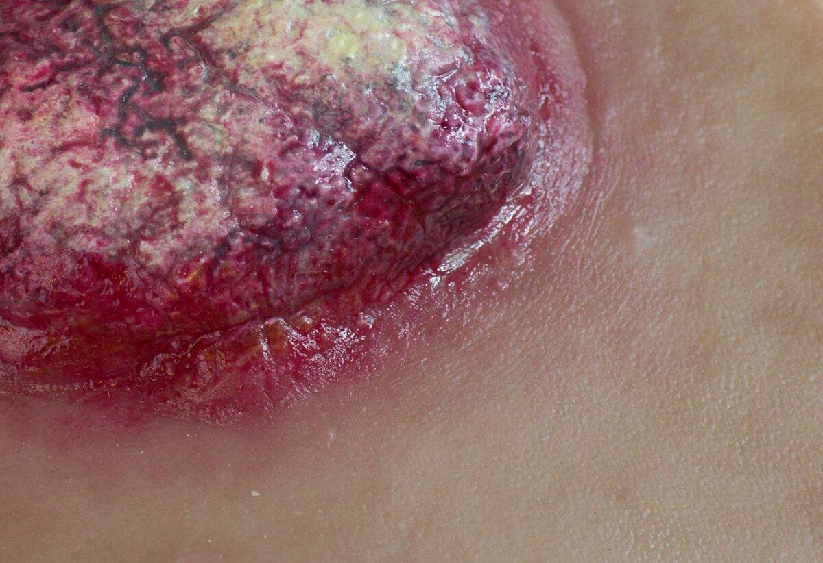 Das "Stick-On Medium Ulcerierendes Mamma-CA"-Modell von MEDICAL FX Germany simuliert ein fortgeschrittenes, ulzerierendes Brustkrebsgeschwür mit hoher Detailgenauigkeit und ist au…