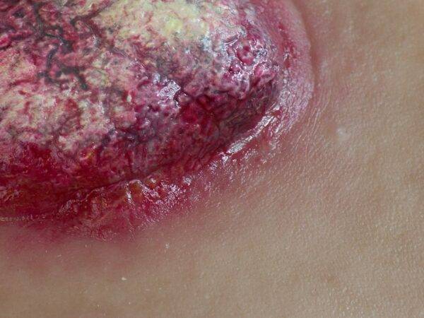 Das "Stick-On Medium Ulcerierendes Mamma-CA"-Modell von MEDICAL FX Germany simuliert ein fortgeschrittenes, ulzerierendes Brustkrebsgeschwür mit hoher Detailgenauigkeit und ist au…