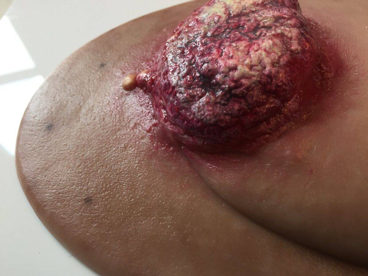 Das "Stick-On Medium Ulcerierendes Mamma-CA"-Modell von MEDICAL FX Germany simuliert ein fortgeschrittenes, ulzerierendes Brustkrebsgeschwür mit hoher Detailgenauigkeit und ist au…