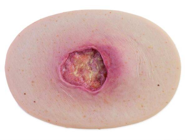 Das „Stick-On Medium Dekubitus Grad 3"-Modell von MEDICAL FX Germany ist eine detailgetreue Nachbildung einer Druckgeschwür-Wunde, wie sie im Stadium 3 auftritt. Eingebettet in ho…