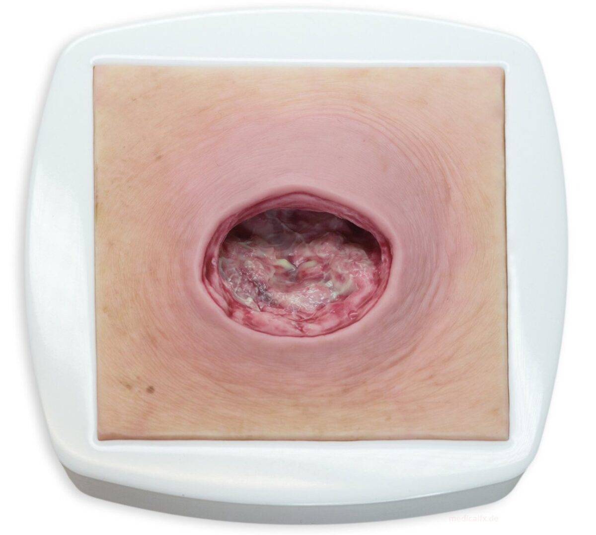 Das „Rahmenmodell Dekubitus mit glattem Wundrand" von MEDICAL FX Germany bietet eine exakte und realistische Darstellung eines Dekubitus mit charakteristisch glatten Wundrändern.…
