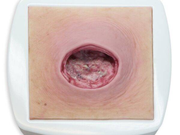 Das „Rahmenmodell Dekubitus mit glattem Wundrand" von MEDICAL FX Germany bietet eine exakte und realistische Darstellung eines Dekubitus mit charakteristisch glatten Wundrändern.…