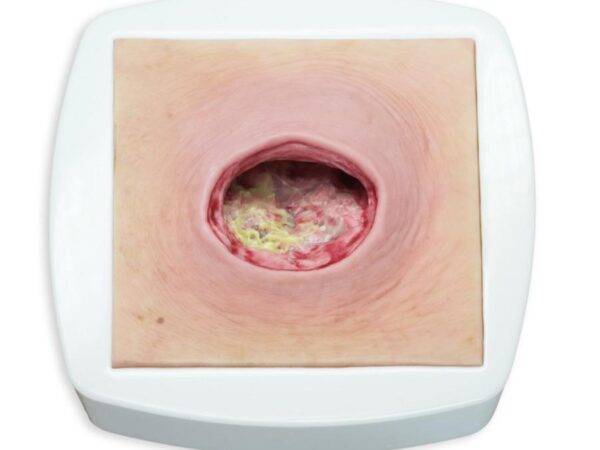 Das „Rahmenmodell Dekubitus mit glattem Wundrand" von MEDICAL FX Germany bietet eine exakte und realistische Darstellung eines Dekubitus mit charakteristisch glatten Wundrändern.…