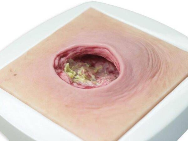 Das „Rahmenmodell Dekubitus mit glattem Wundrand" von MEDICAL FX Germany bietet eine exakte und realistische Darstellung eines Dekubitus mit charakteristisch glatten Wundrändern.…