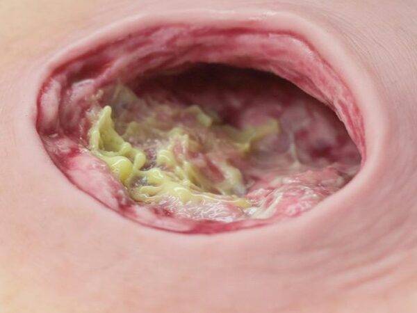 Das „Fibrinimitat“ von MEDICAL FX Germany zur Darstellung von Fibrinfaserstoff als Wundbelag auf künstlichen Wunden wurde eigens von uns entwickelt. Es kann auch für die Imitation…